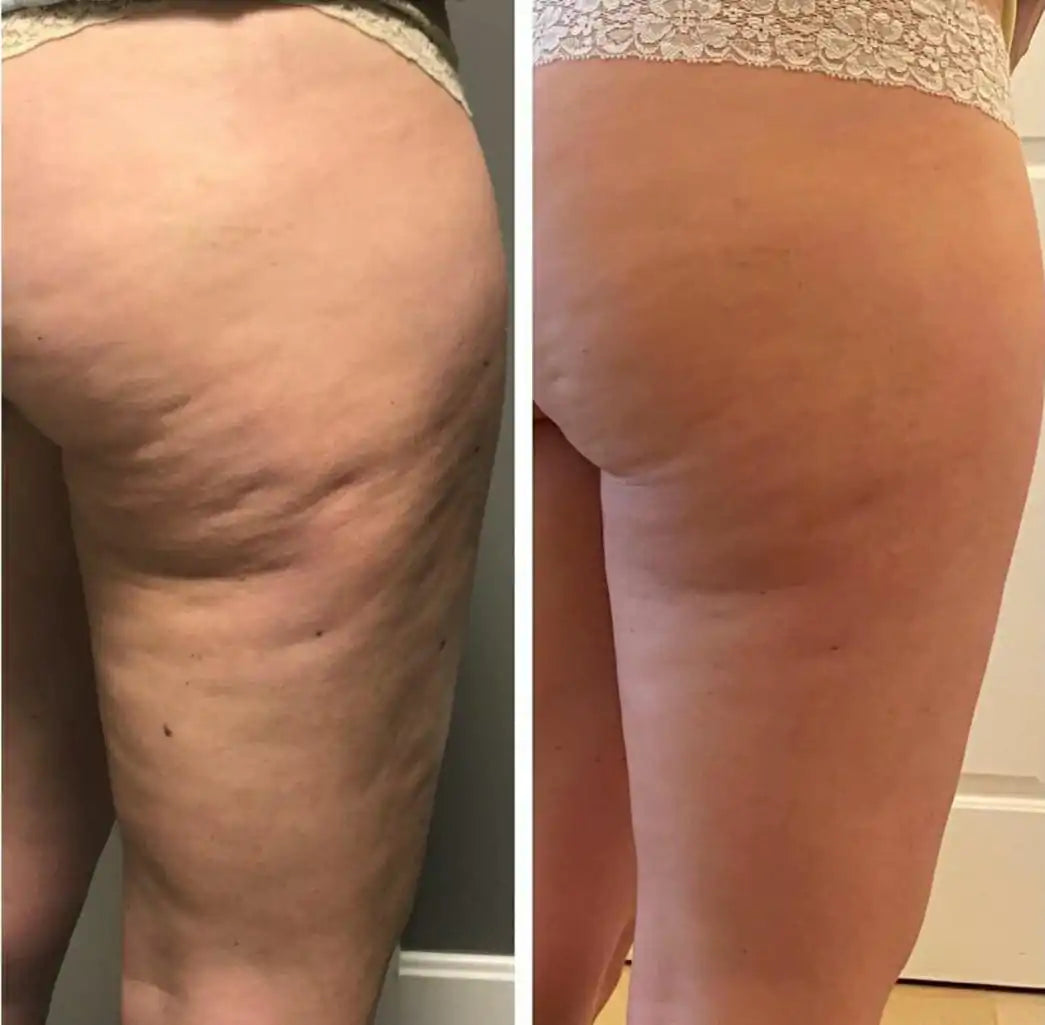 BodyCellu360™ | Appareil Corps Sculptant Anti Cellulite